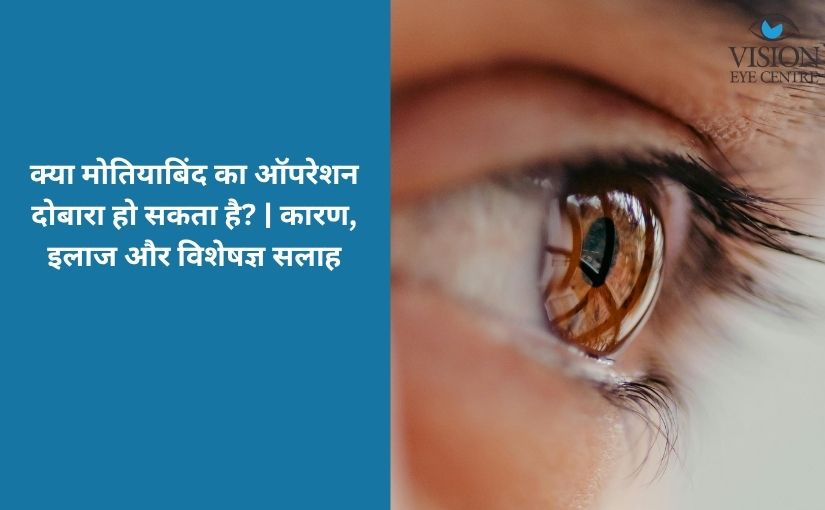 क्या मोतियाबिंद का ऑपरेशन दोबारा हो सकता है? | कारण, इलाज और विशेषज्ञ सलाह