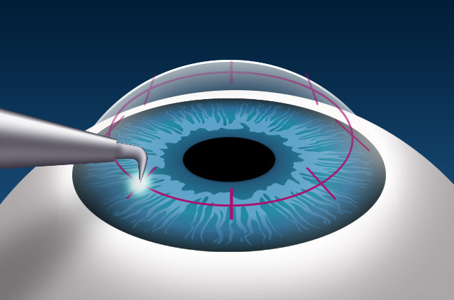 How Long Does Cornea Transplant Surgery Take?