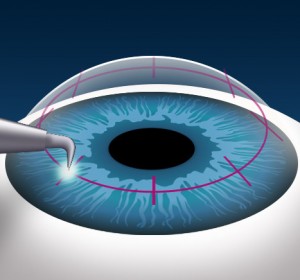How Long Does Cornea Transplant Surgery Take?
