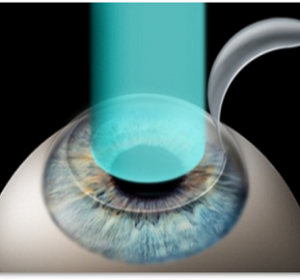 Vision Eye Centre Weighing the Vision Benefits Against the Side Effects, Cost, and Recovery Time