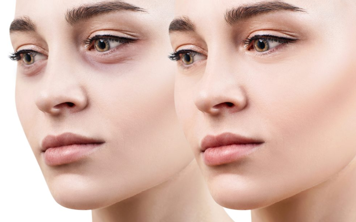 What is the blepharoplasty surgery? What is a good age for blepharoplasty?