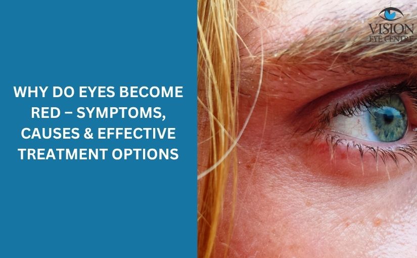 why do eyes become red – Symptoms, Causes & Effective Treatment Options