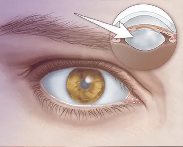 Cataract Surgery in Delhi: Vision Eye Centre