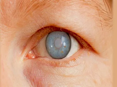 Glaucoma Specialist Doctor in Delhi | Glaucoma Treatment : Vision Eye Centre