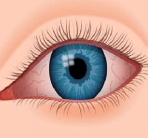 Dry Eye Treatment in Delhi: Vision Eye Centre