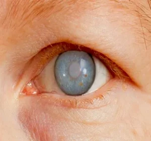 Glaucoma Specialist Doctor in Delhi | Glaucoma Treatment : Vision Eye Centre