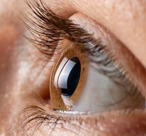 Keratoconus Treatment in Delhi: Vision Eye Centre