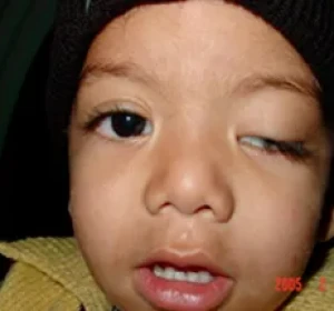 Pediatric Ophthalmologist in Delhi​: Vision Eye Centre